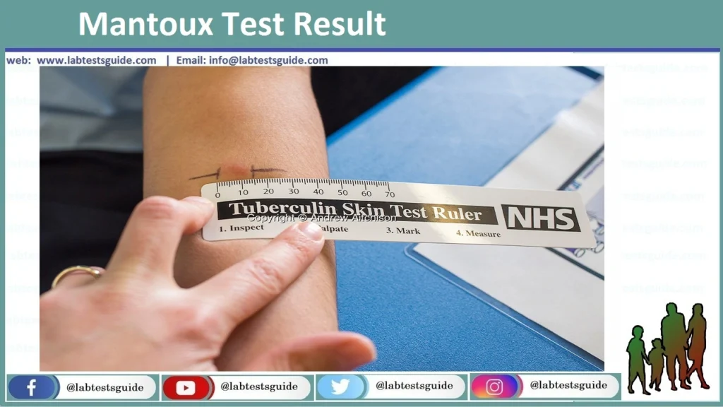 TB Skin Test: Test Purpose, Procedure, Result Interpretation and more