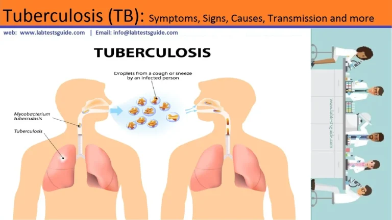 Tuberculosis (TB)