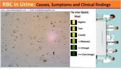 RBC in Urine: Causes and Clinical Significations - Lab Tests Guide
