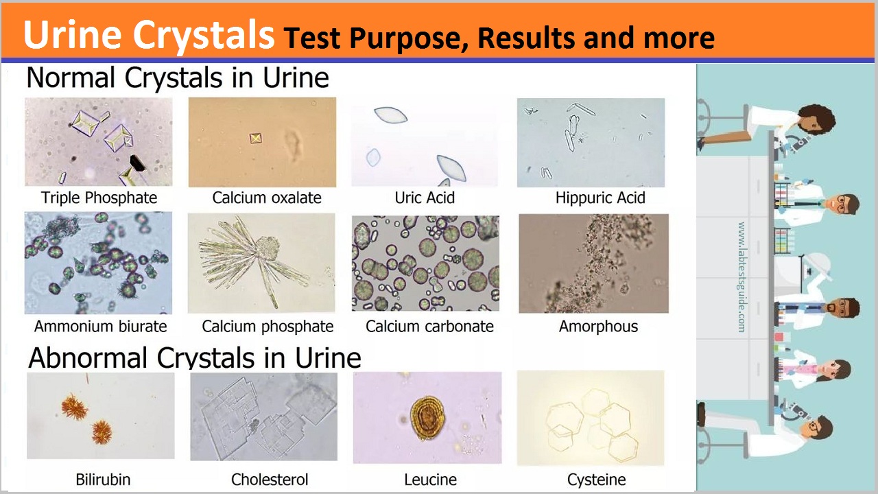 What does it mean to have amorphous crystals in urine Urine Crystals Test Purpose Procedure Results And More Lab Tests Guide