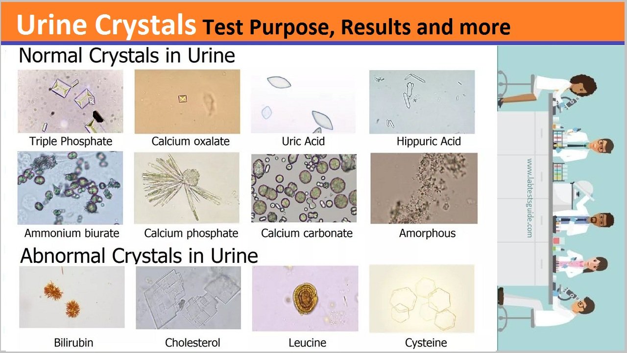 uric acid crystals in urine