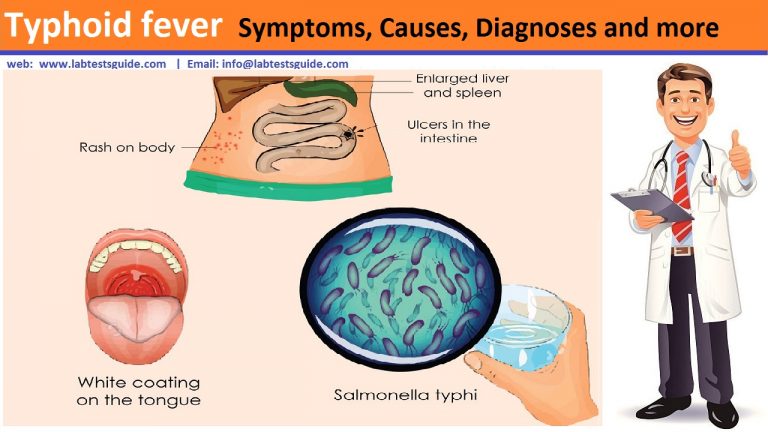 Typhoid Fever