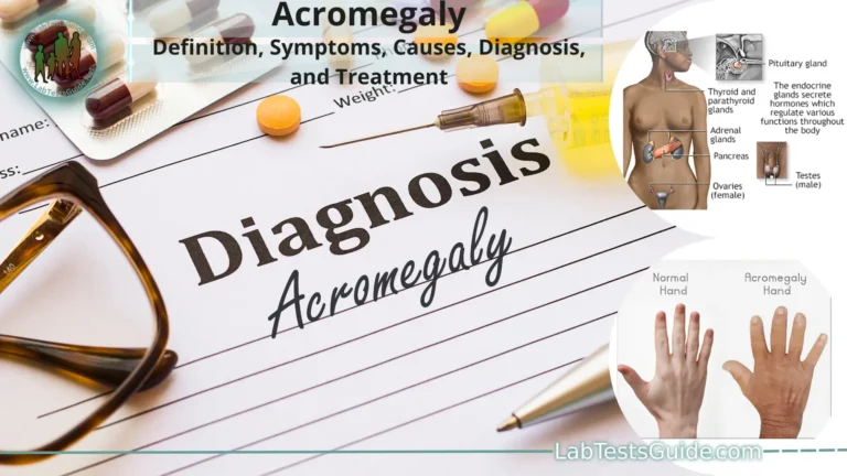 Acromegaly