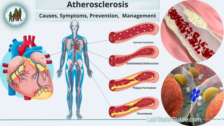 Atherosclerosis