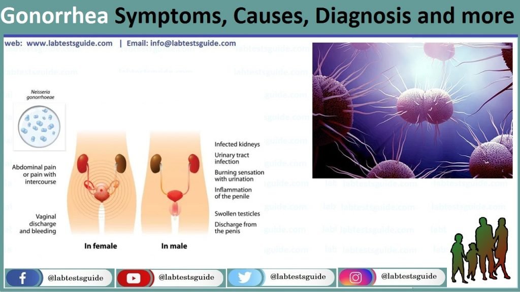 Gonorrhea Gonorrhea