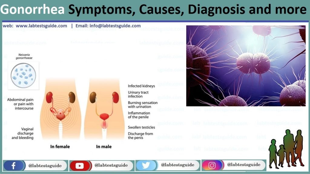 Gonorrhea