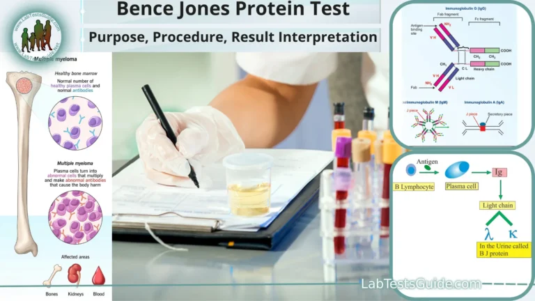 Bence Jones Protein Test