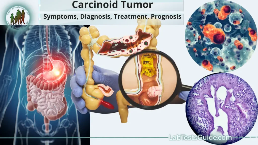 Carcinoid Tumor Carcinoid Tumor
