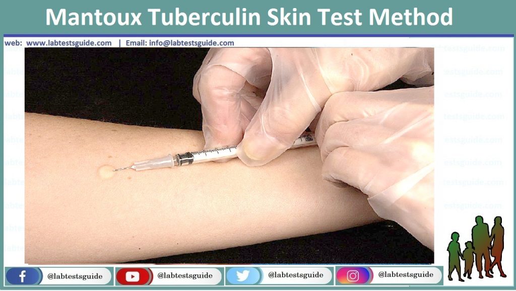 Mantoux Tuberculin Skin Test Method