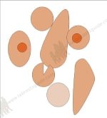 &nbsp;Poikilocytosis