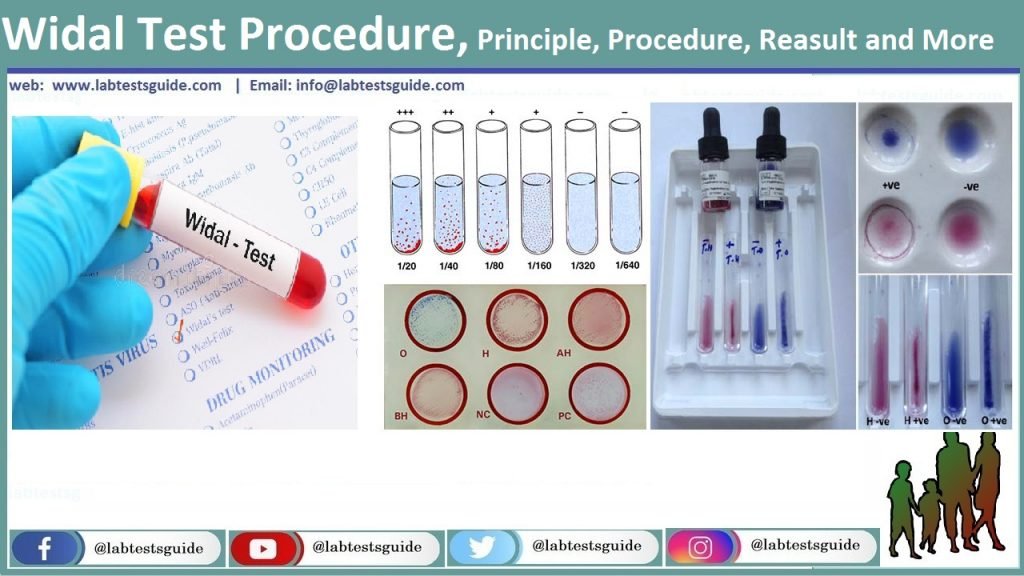 Widal Test widal test procedure