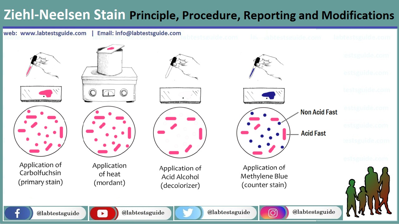 Ziehl-Neelsen Stain (ZN-Stain) : Principle, Procedure, Reporting and Modifications