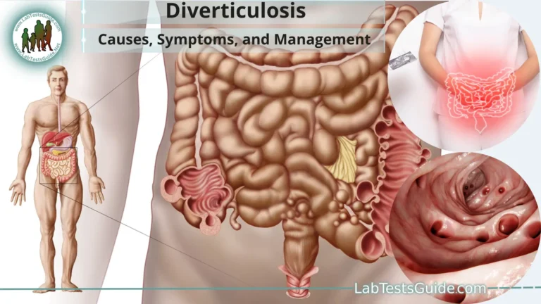 Diverticulosis