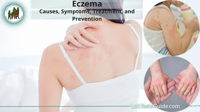 Eczema
