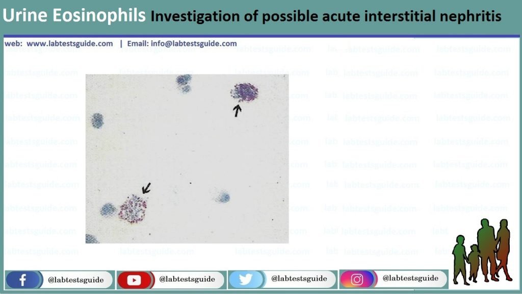 Urine Eosinophils Urine Eosinophils