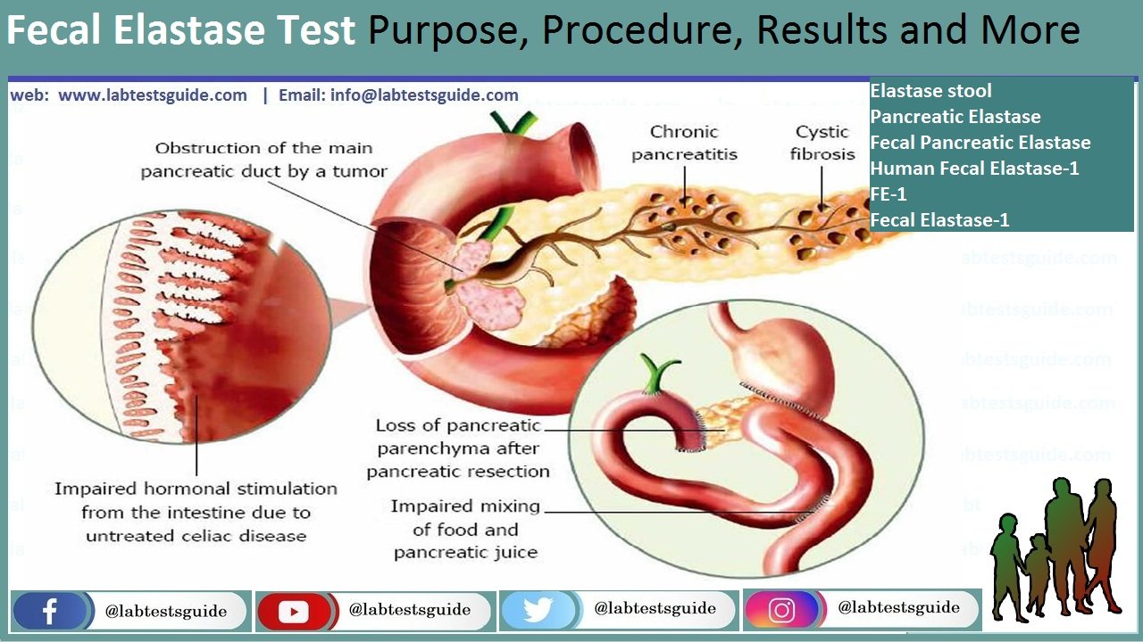Fecal Elastase Test Fecal Elastase Test