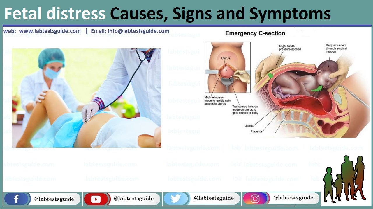 Fetal distress Fetal distress