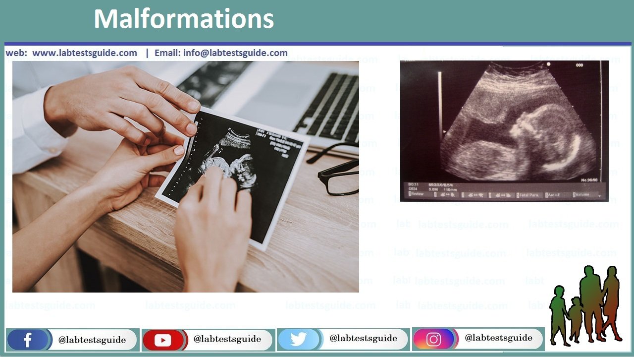 Malformations Malformations