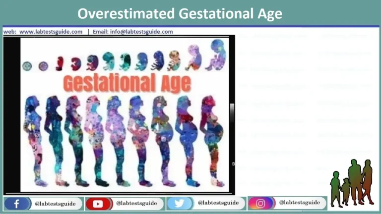 Overestimated Gestational Age