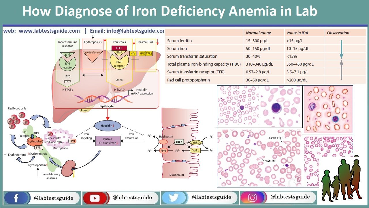 How Diagnose of Iron Deficiency Anemia in Lab