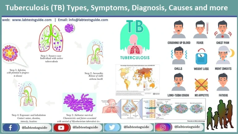 TB (Tuberculosis )