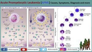 Acute Promyelocytic Leukemia (APML) Symptoms, Diagnosis And More | Lab ...