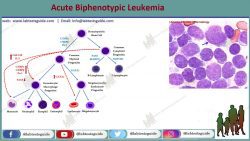 Acute Biphenotypic Leukemia