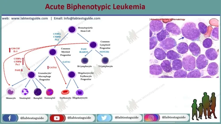 Acute Biphenotypic Leukemia