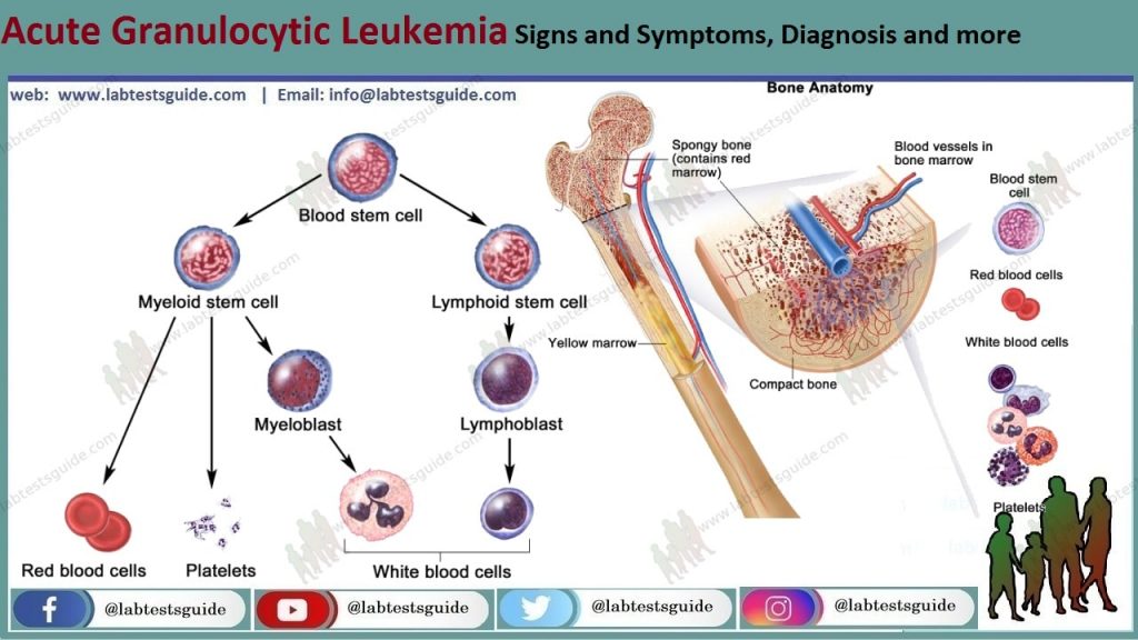 Acute Granulocytic Leukemia