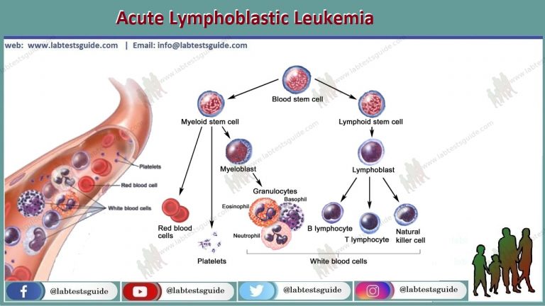 Acute Lymphoblastic Leukemia (ALL)