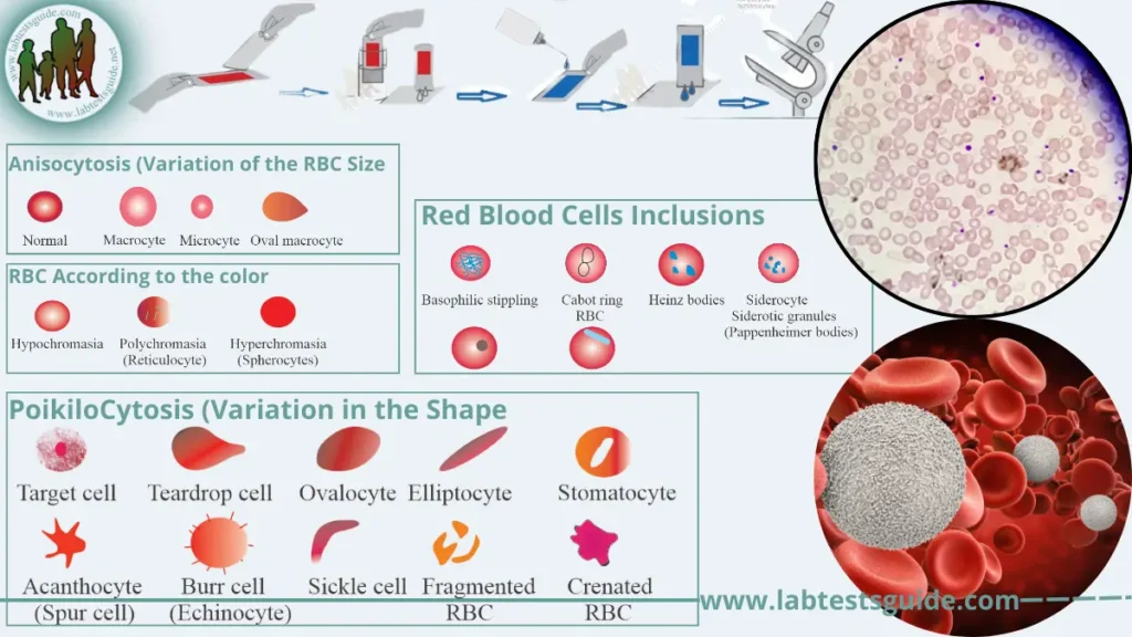 Blood Smear Analysis Blood Smear Analysis