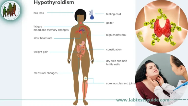 Hypothyroidism