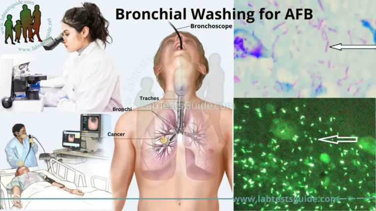 Bronchial Washing for AFB