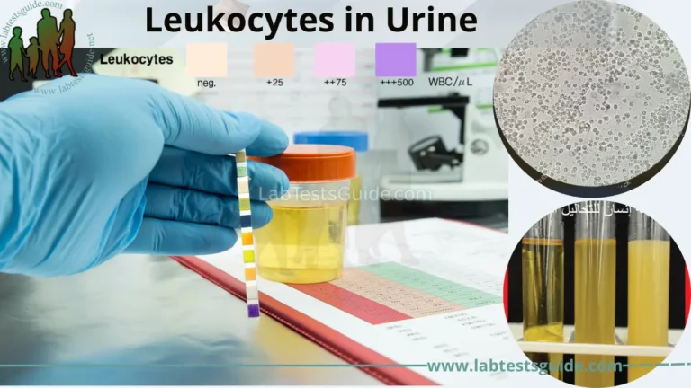 Leukocytes in Urine