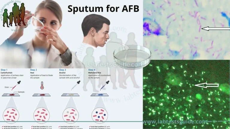 Sputum for AFB
