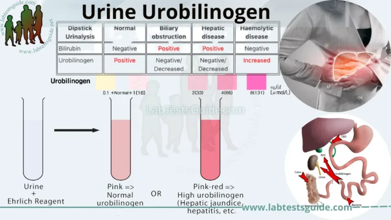 Urine Urobilinogen
