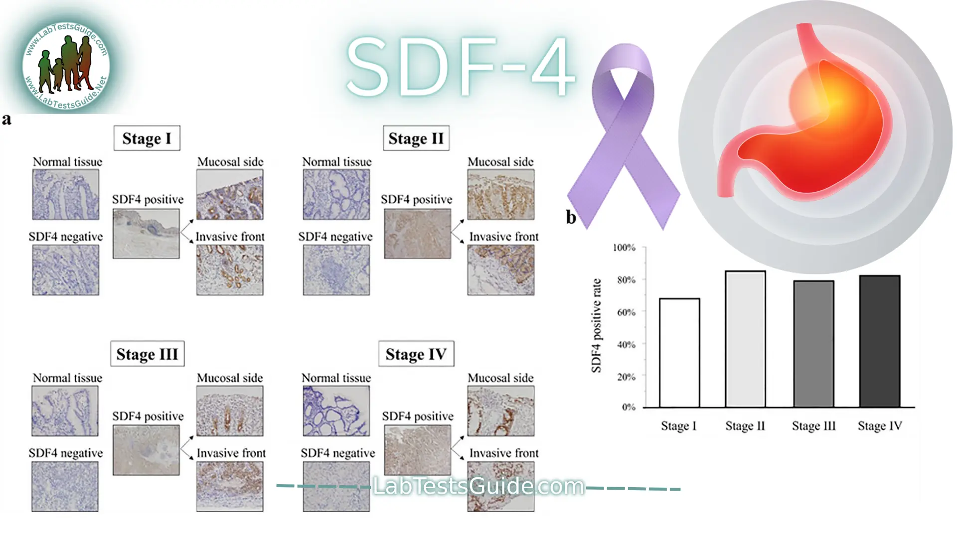 Scientists Develop New Tumor Marker Test (SDF4) with Nearly 90