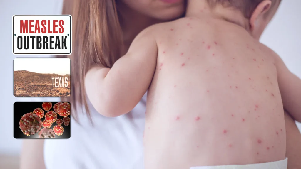 Measles Outbreaks in West Texas Lead to Cases of Vitamin A Toxicity in Children Measles Outbreaks in West Texas Lead to Cases of Vitamin A Toxicity in Children